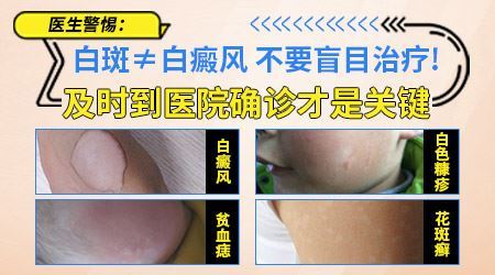 白癜风疑似症状